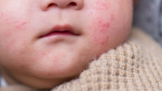 A baby resting calmly in soft natural light, illustrating a guide to telling common infant rashes apart