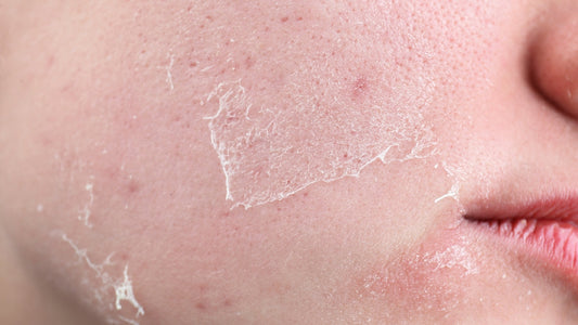 Does a Silk Pillowcase Help Acne? A Balanced Look at What It Can (and Can’t) Do